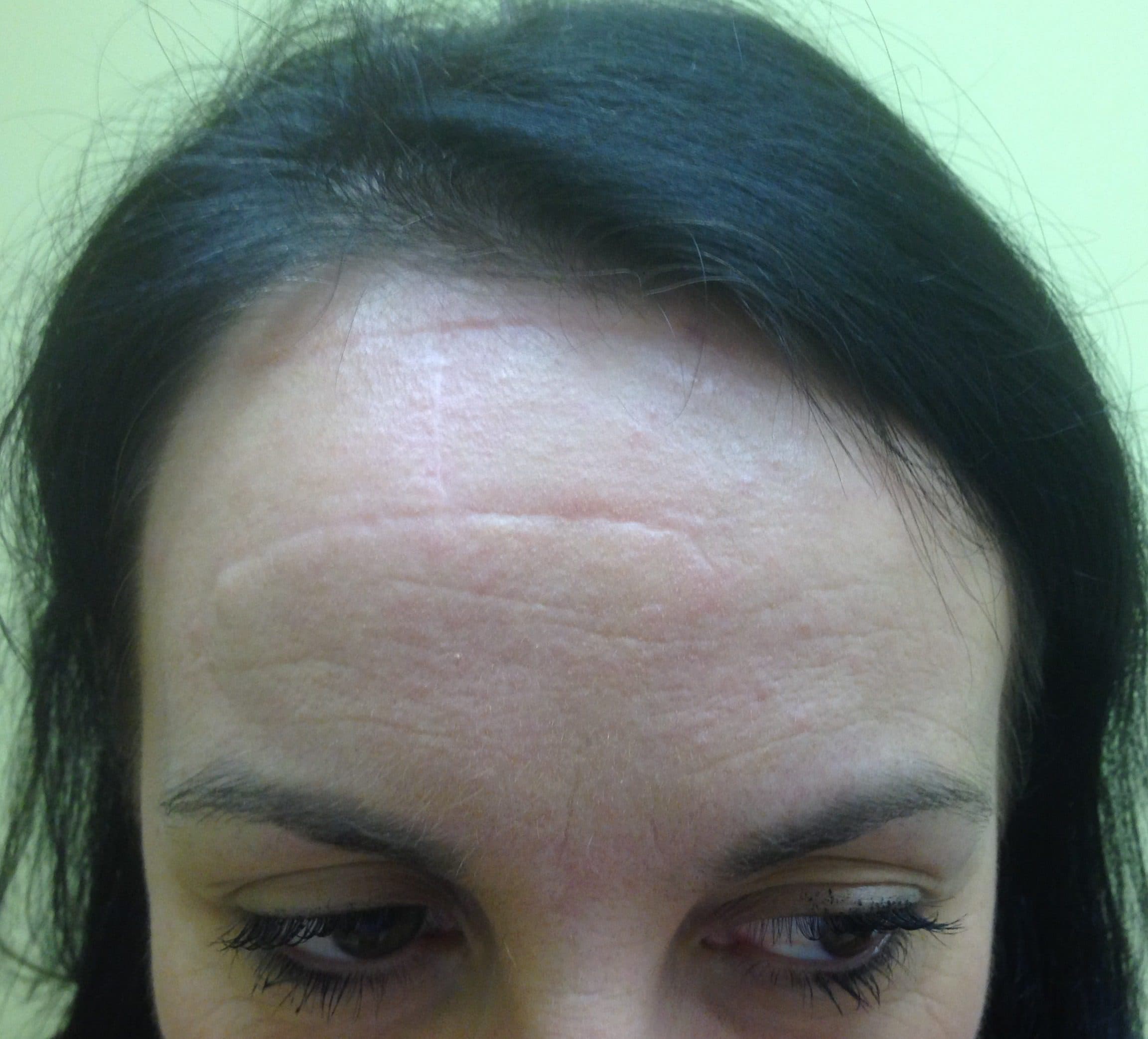 Skin Cancer Surgery after
