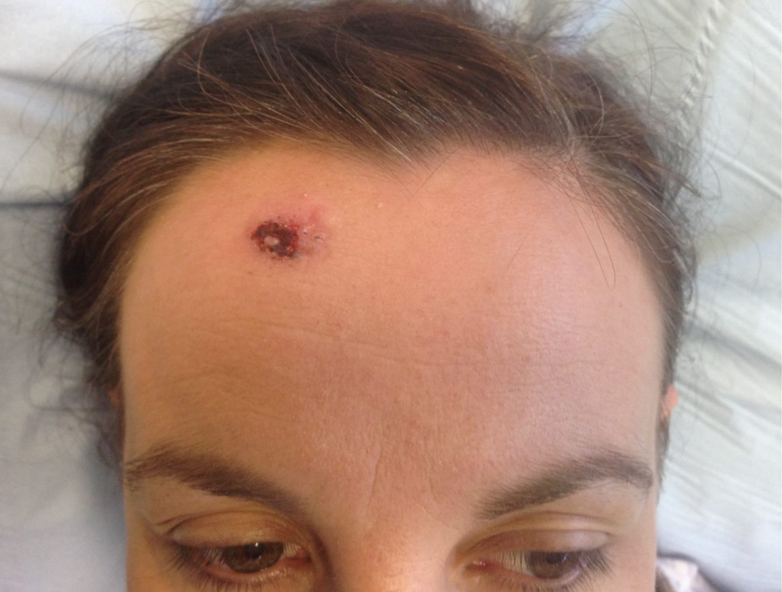 Skin Cancer Surgery