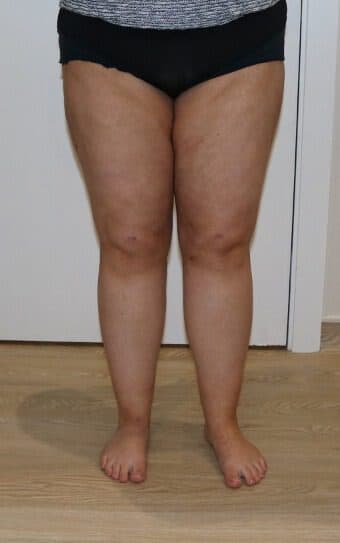 Thigh Liposuction after