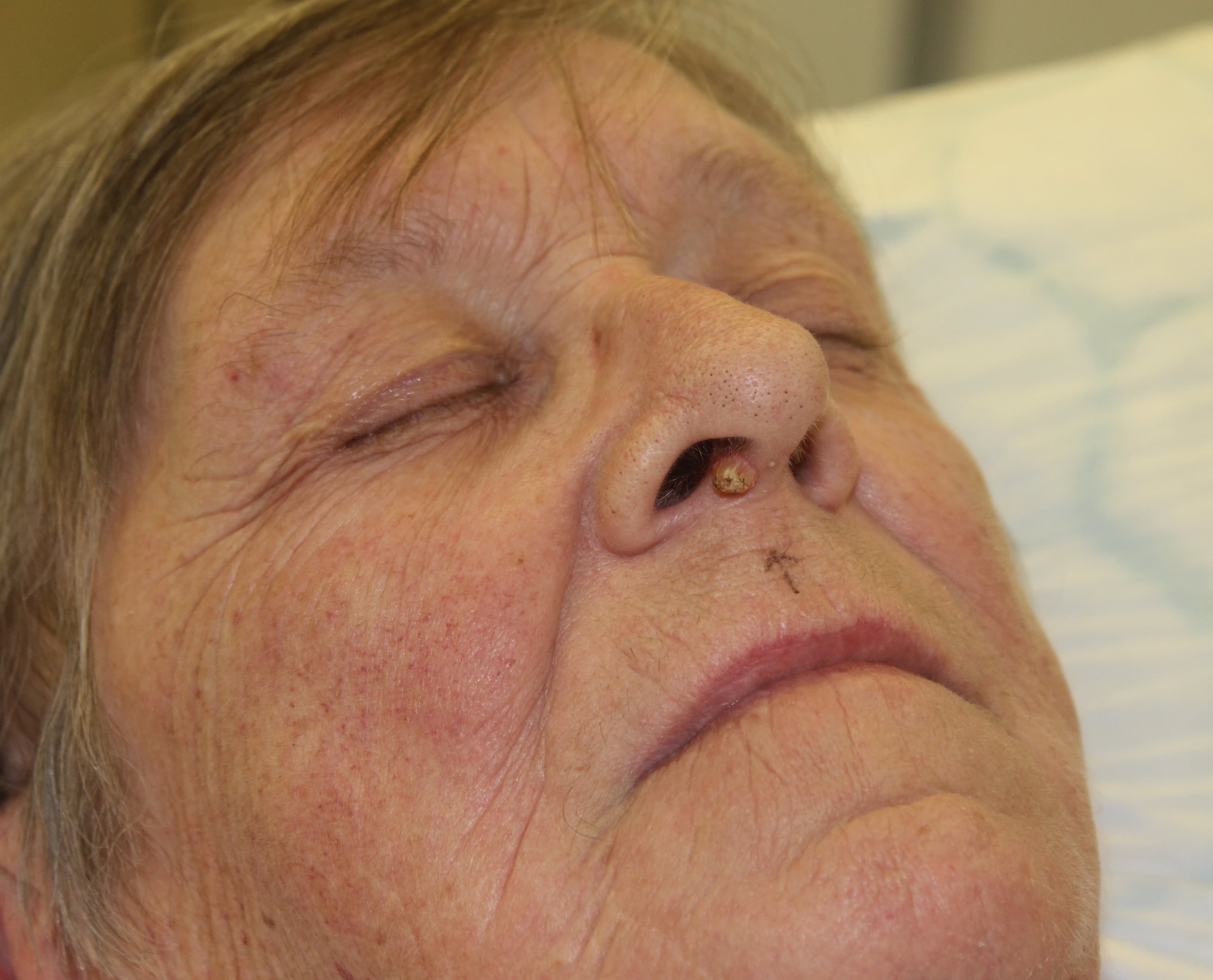 Skin Cancer Surgery