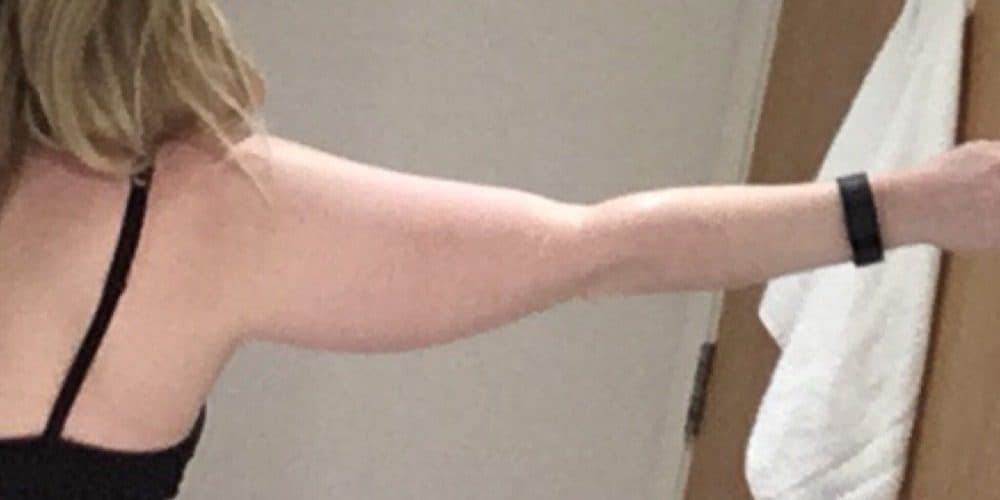 Arm Lift (Brachioplasty)