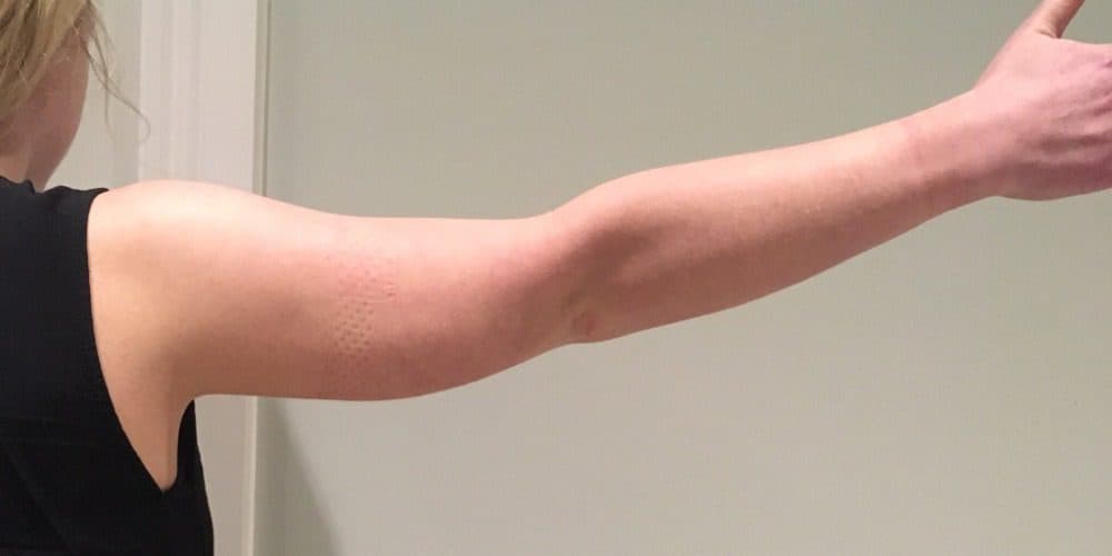 Arm Lift (Brachioplasty) after