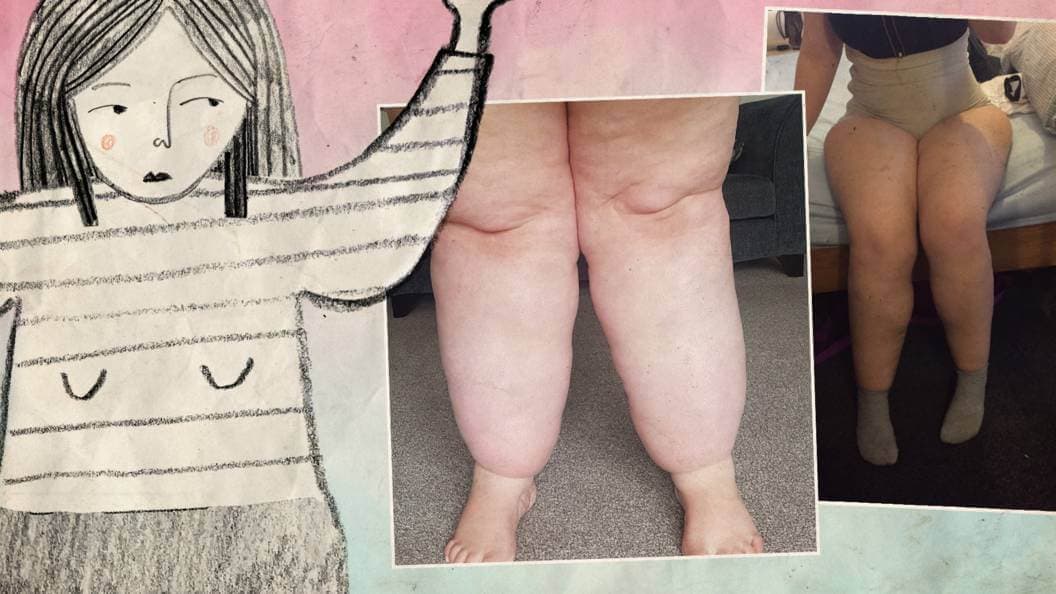 I’m not fat, I’ve got lipoedema