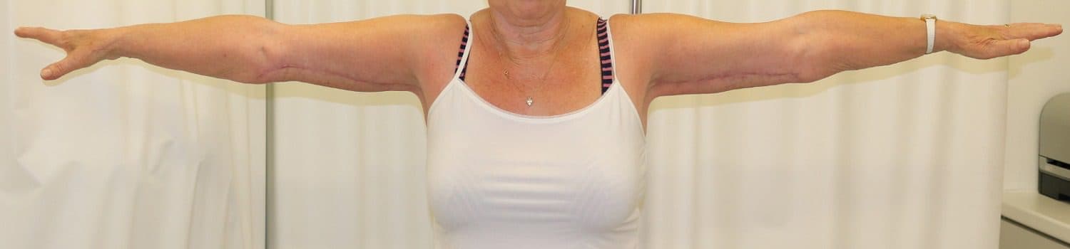 Arm Lift (Brachioplasty) after
