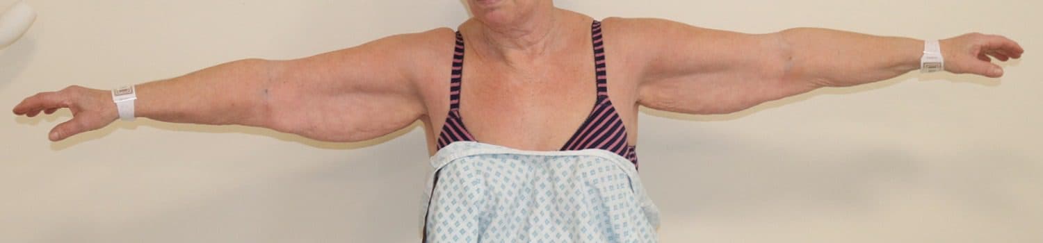 Arm Lift (Brachioplasty)