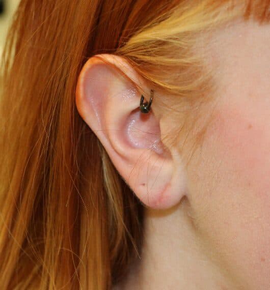 Earlobe Repair after