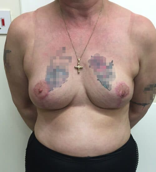Breast Lift Mastopexy after