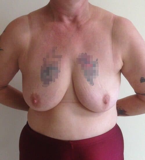Breast Lift Mastopexy