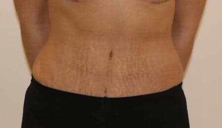 Tummy Tuck (Abdominoplasty) after