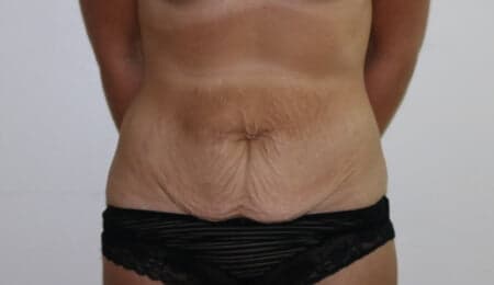 Tummy Tuck (Abdominoplasty)