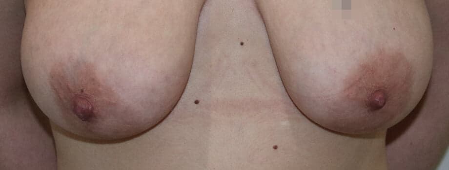 Areola Reduction