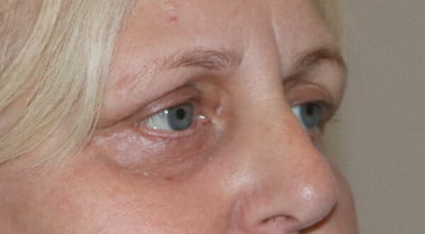 Chemical Peel after