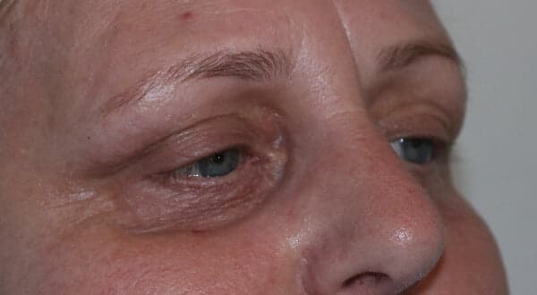 Chemical Peel