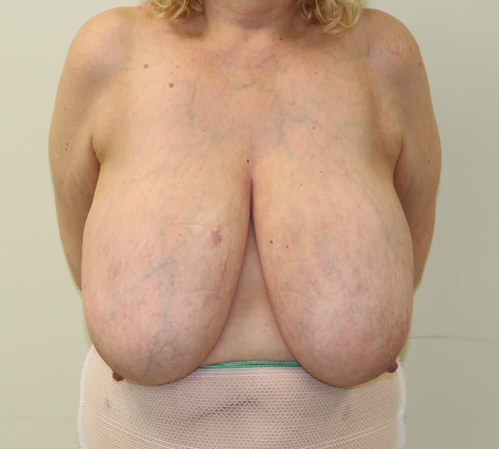 Breast Reduction