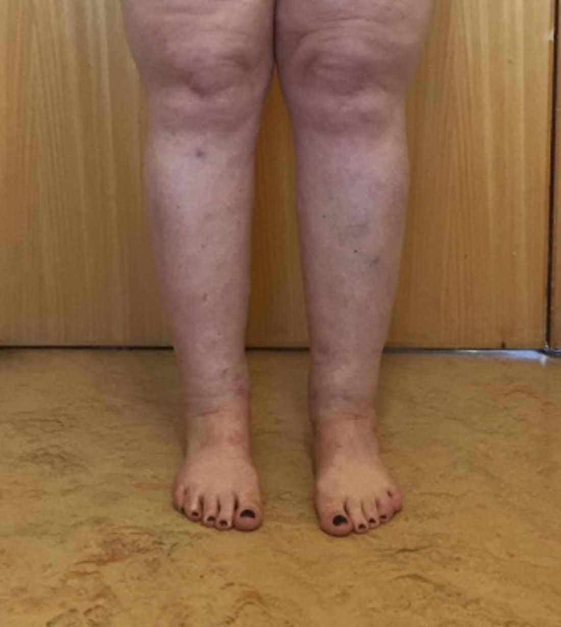 Ankle (Cankle) Contouring after