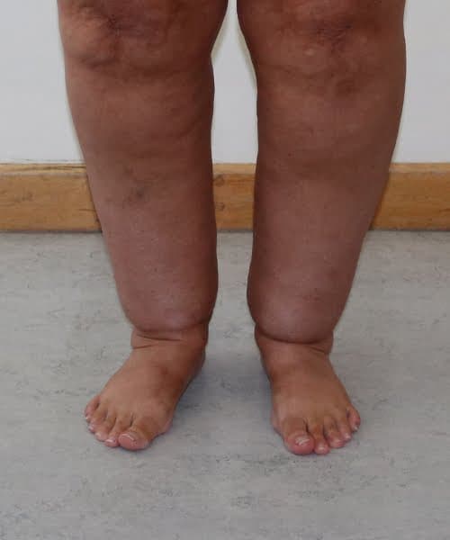 Ankle (Cankle) Contouring
