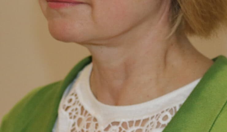 Neck Lift after