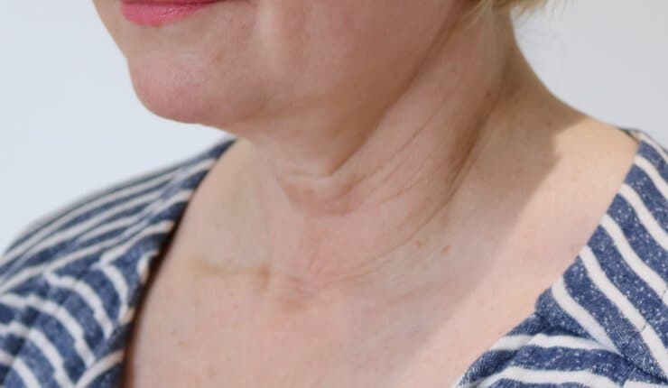 Neck Lift