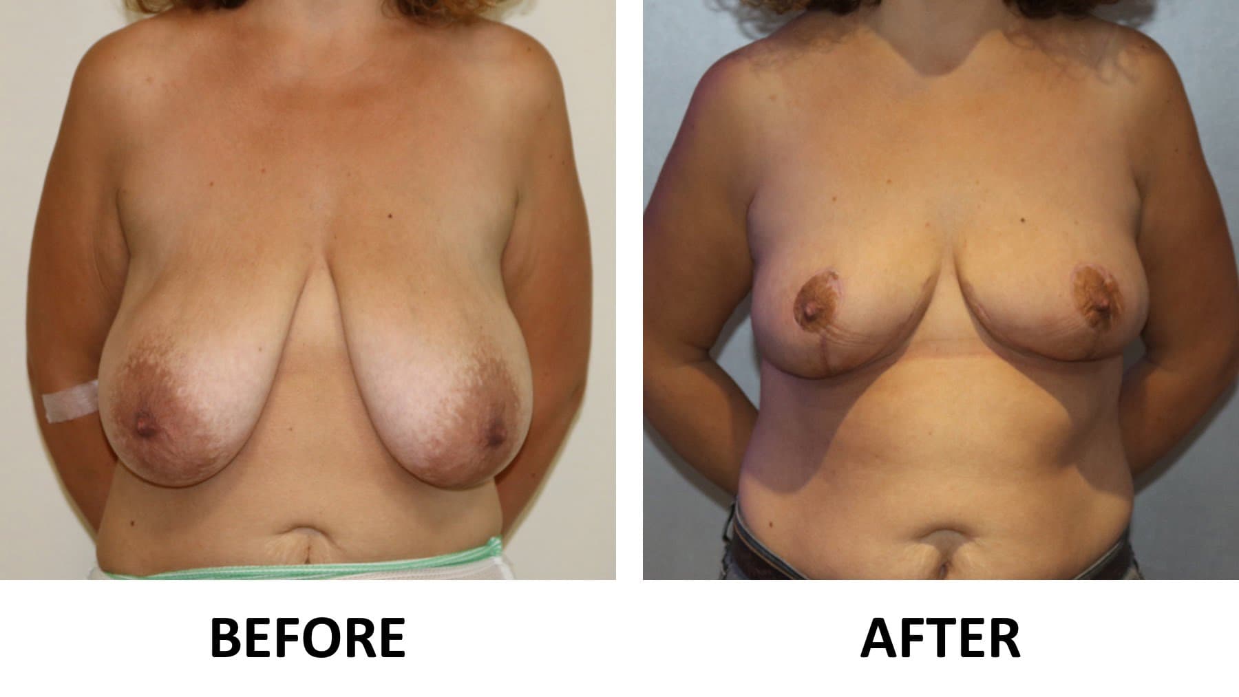 Breast Reduction