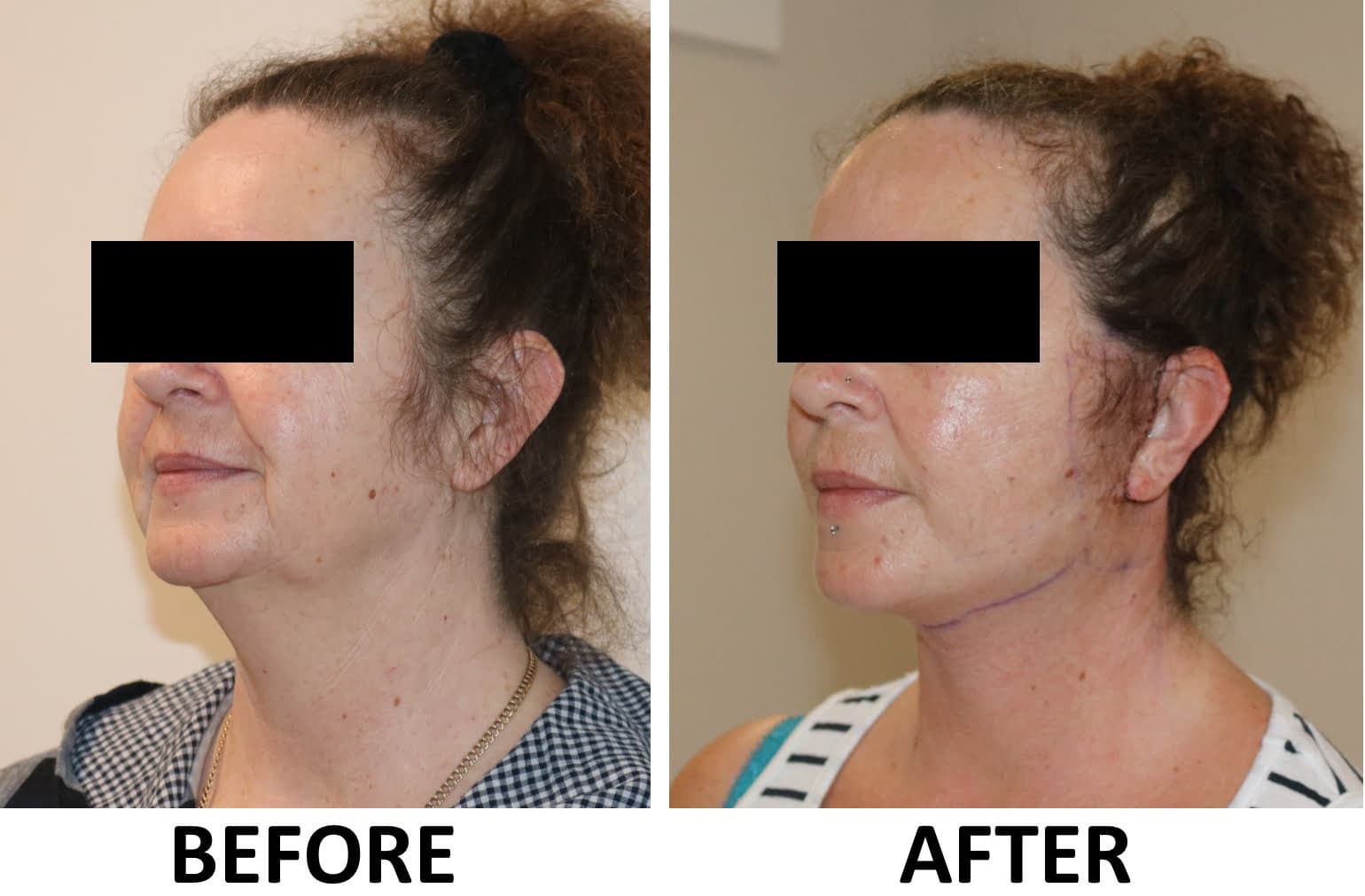 Facelift