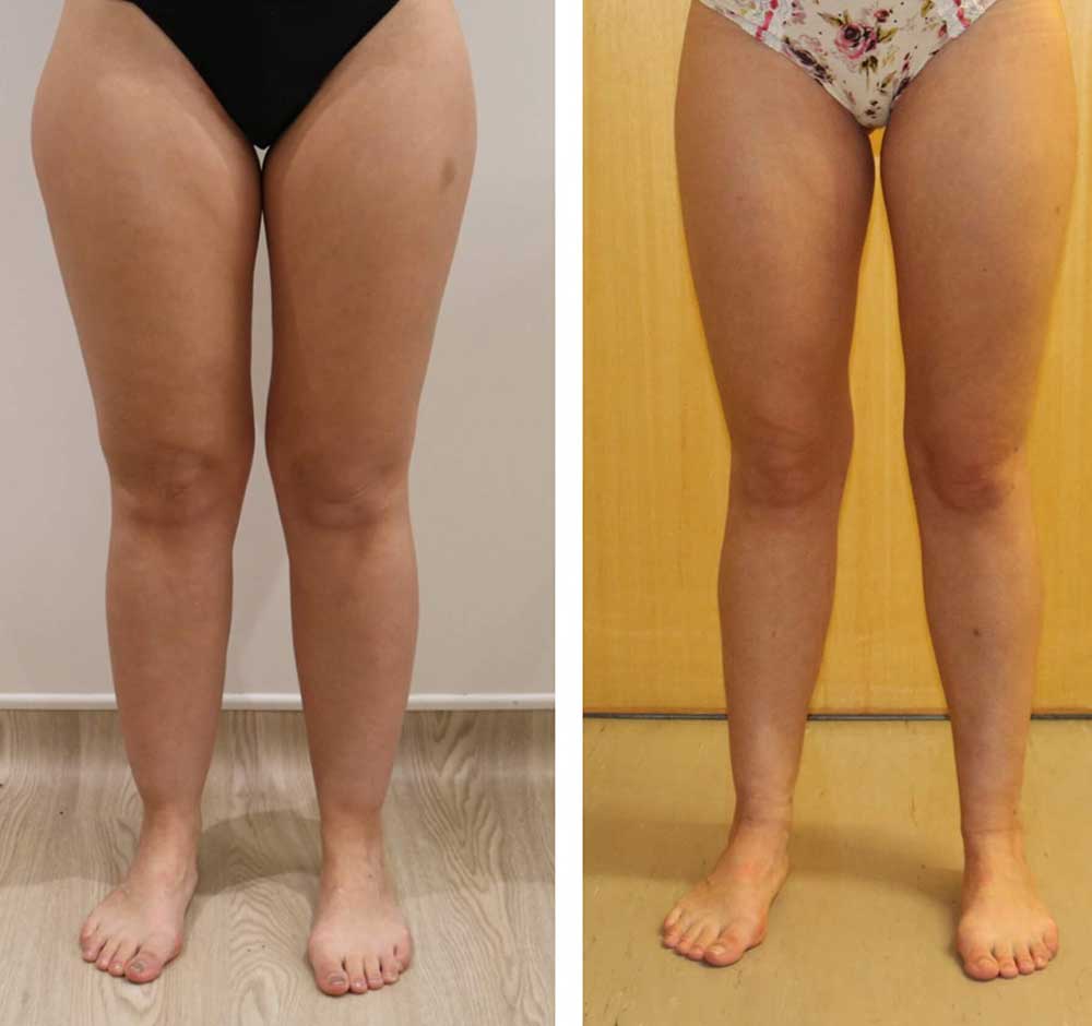 Define Your Lower Limbs with Lower Limb Liposculpture at The Karri Clinic