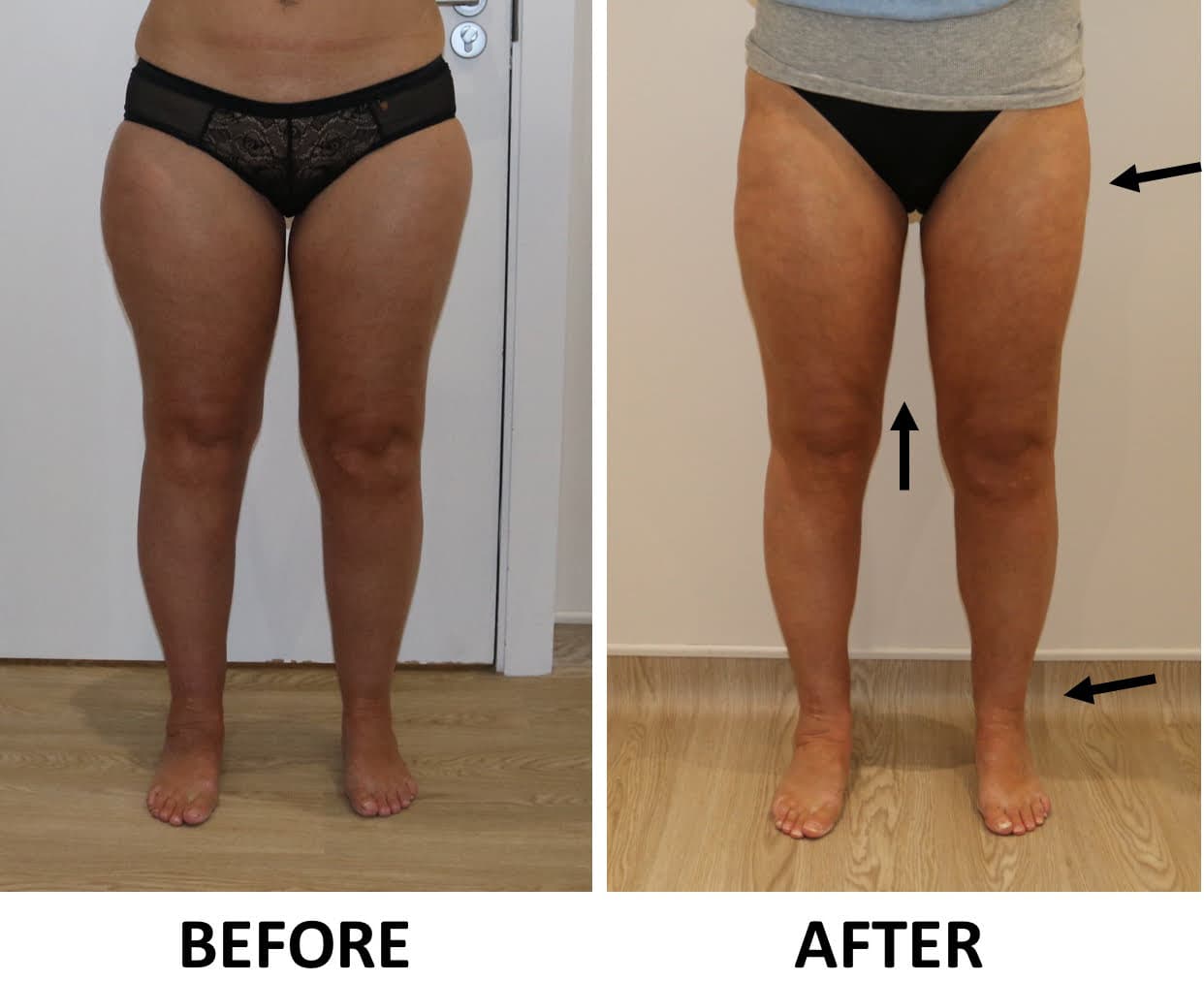 Lower limb liposculpture