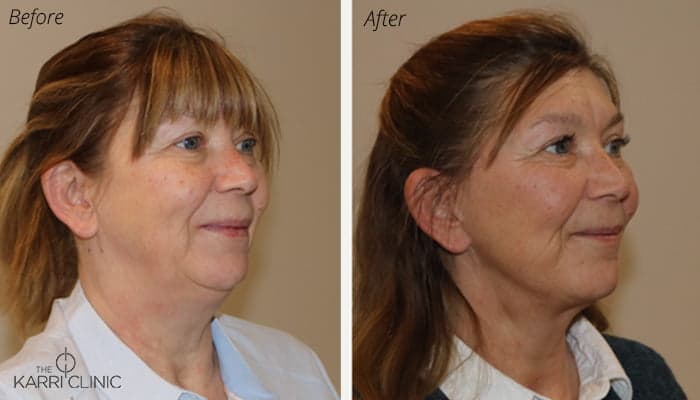 Everything you Need to Know About… Getting a Facelift