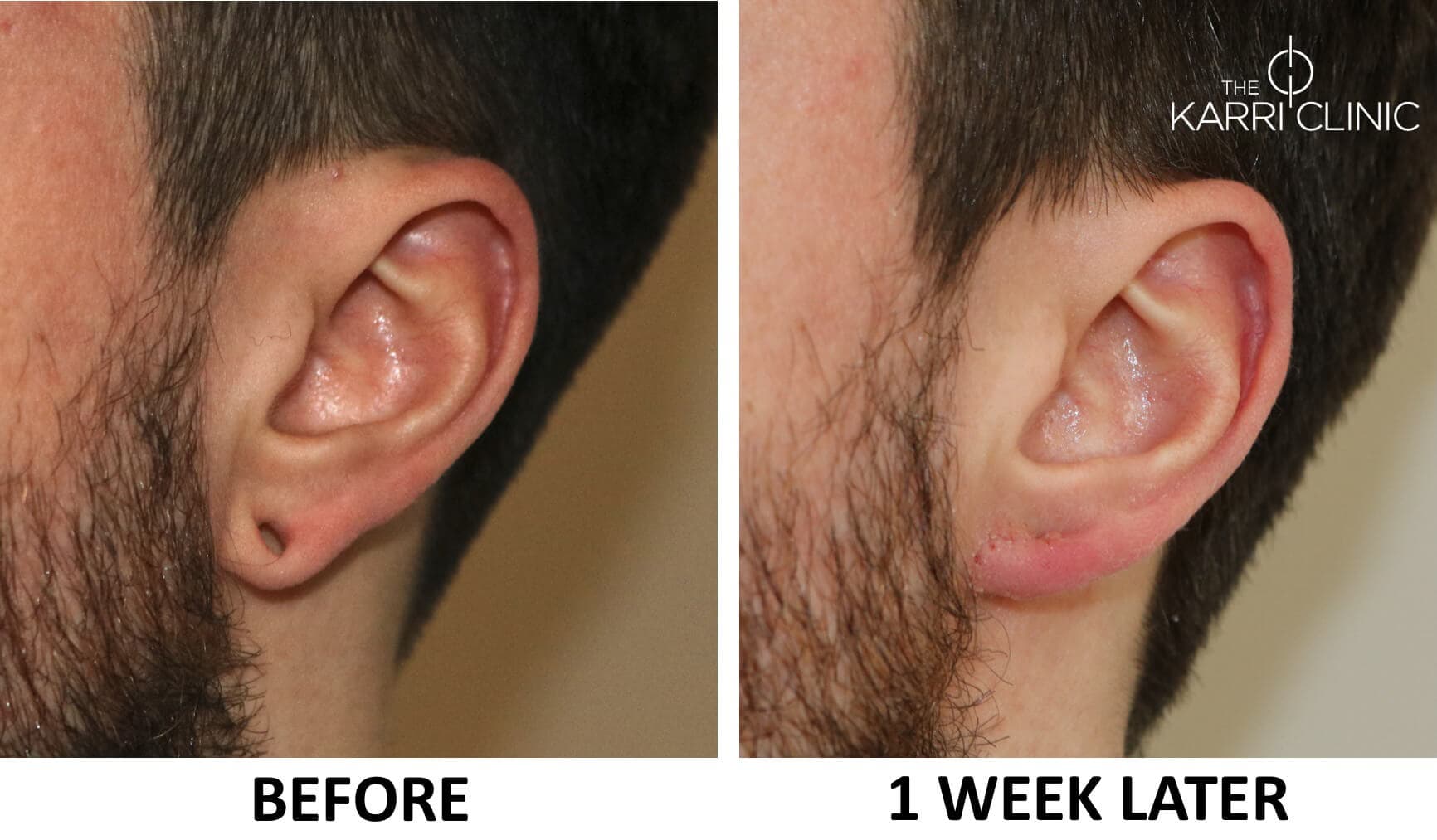 Tribal / Earplug Repair