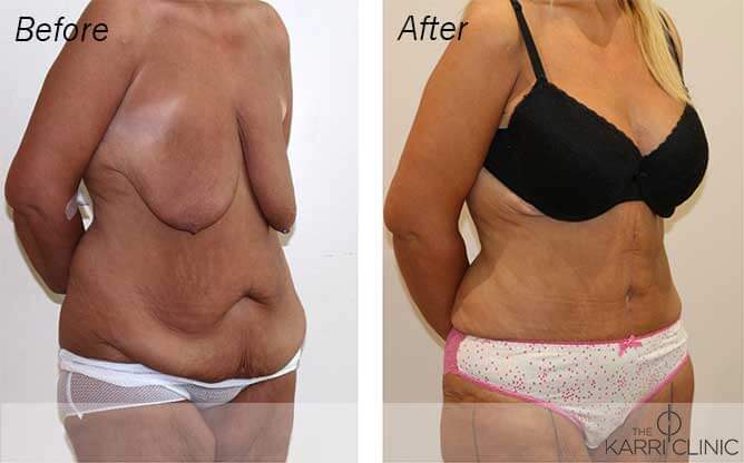 Mummy Makeover - An Unbelievable Transformation