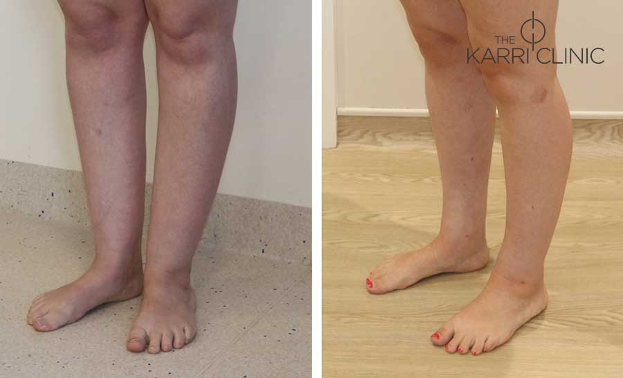 Ankle Sculpting - A Patient Before and After