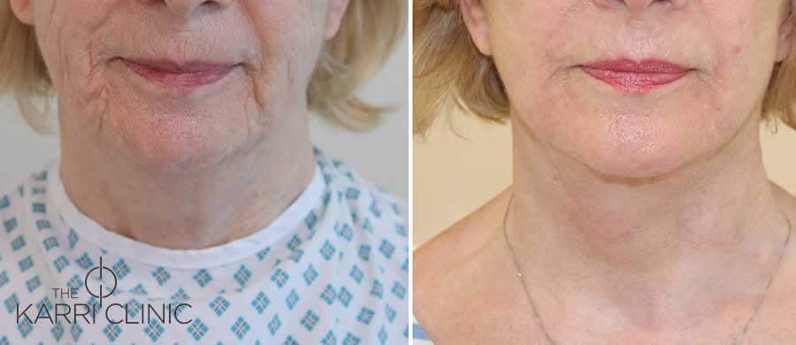 An Amazing Transformation - Facelift, Necklift & Phenol Peel
