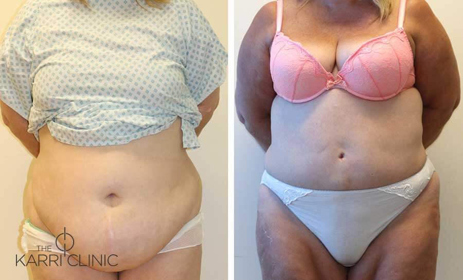 Before and After - A Brazilian Tummy Tuck by Mr Karri