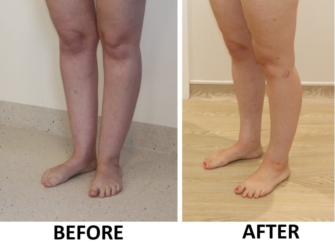 Ankle (Cankle) Contouring