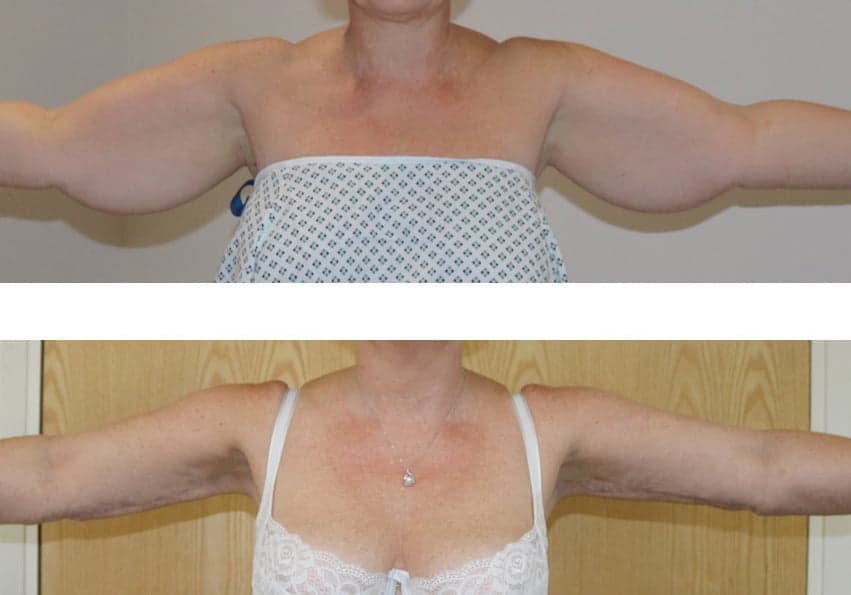 Before and After: Arm Lift on a Patient with Type IV Stage II Lipoedema