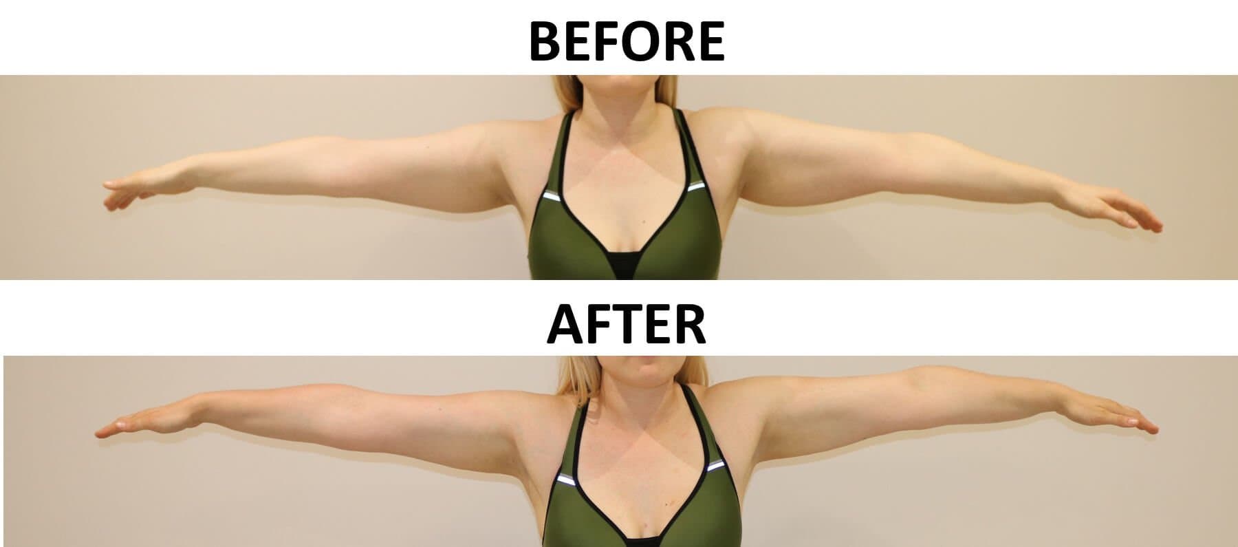 Arm Liposuction
