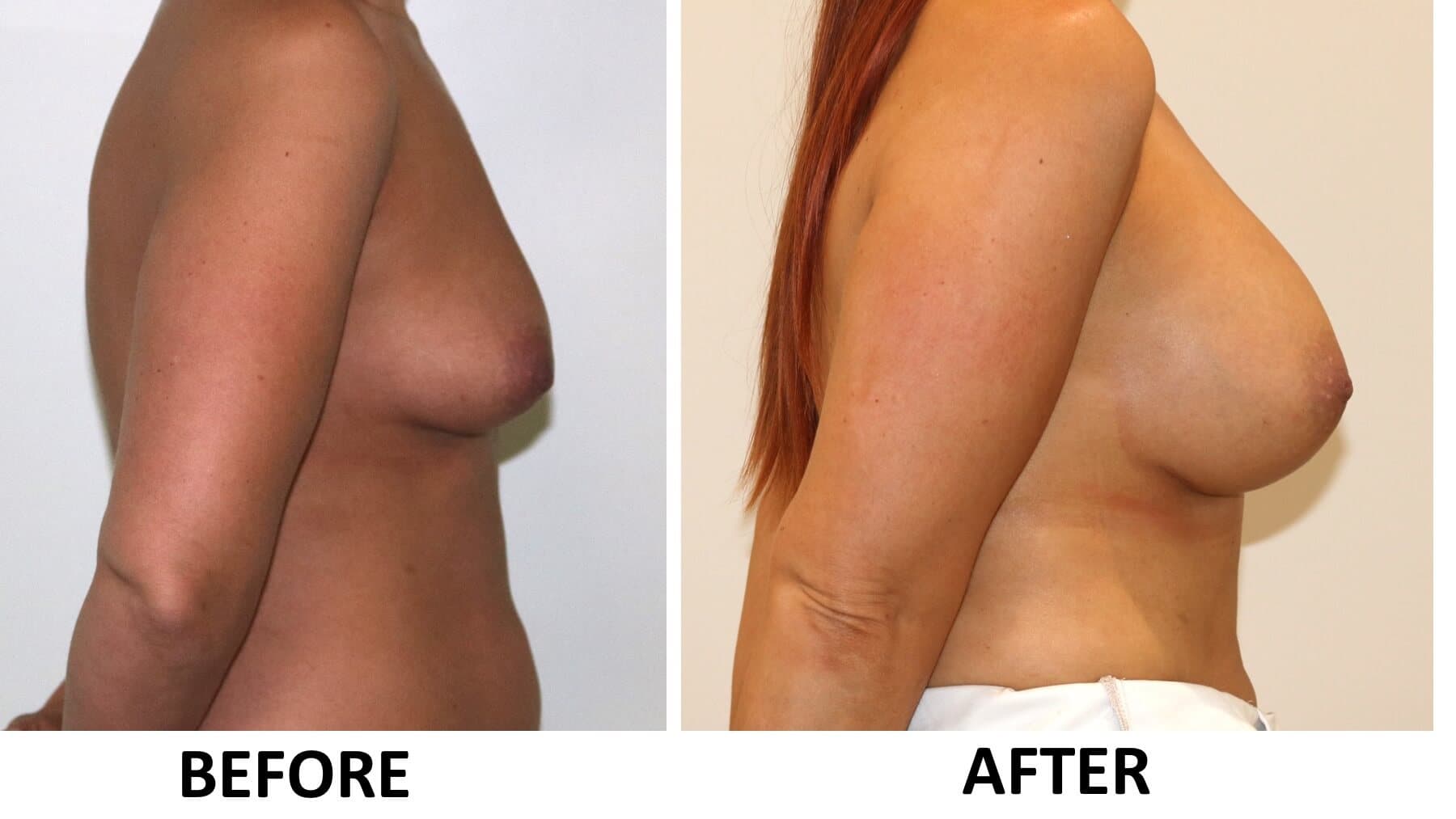 Breast Enlargement