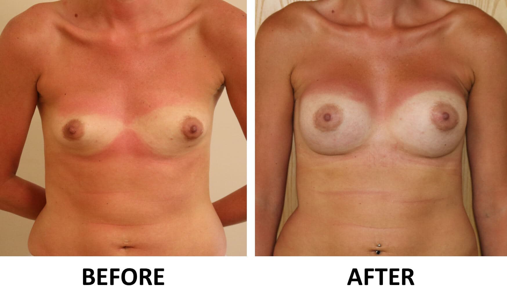 Breast Enlargement