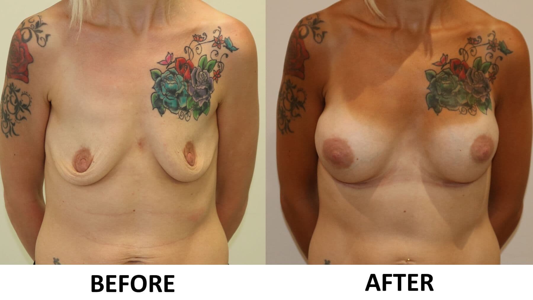 Breast Enlargement