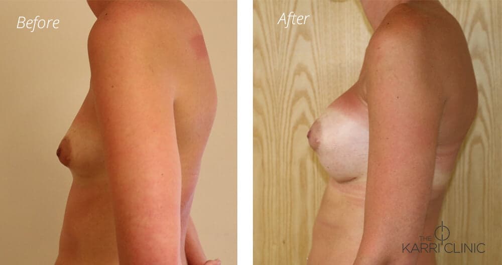 Breast Enlargement Before and After - A Lovely Natural Look