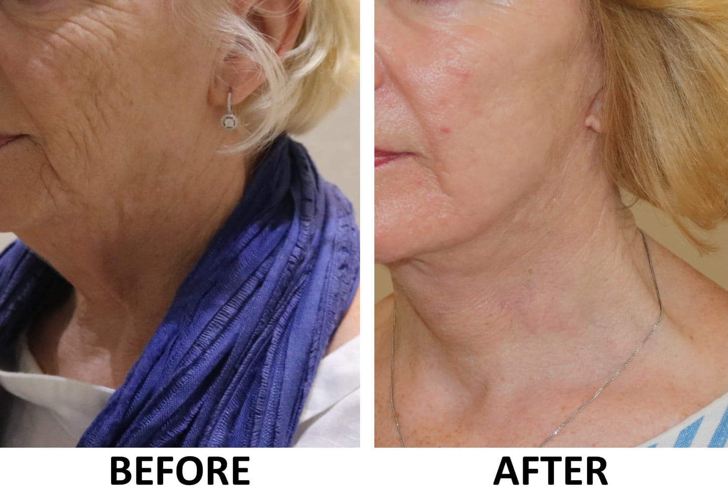 Facelift, Necklift & Full Face Phenol Peel
