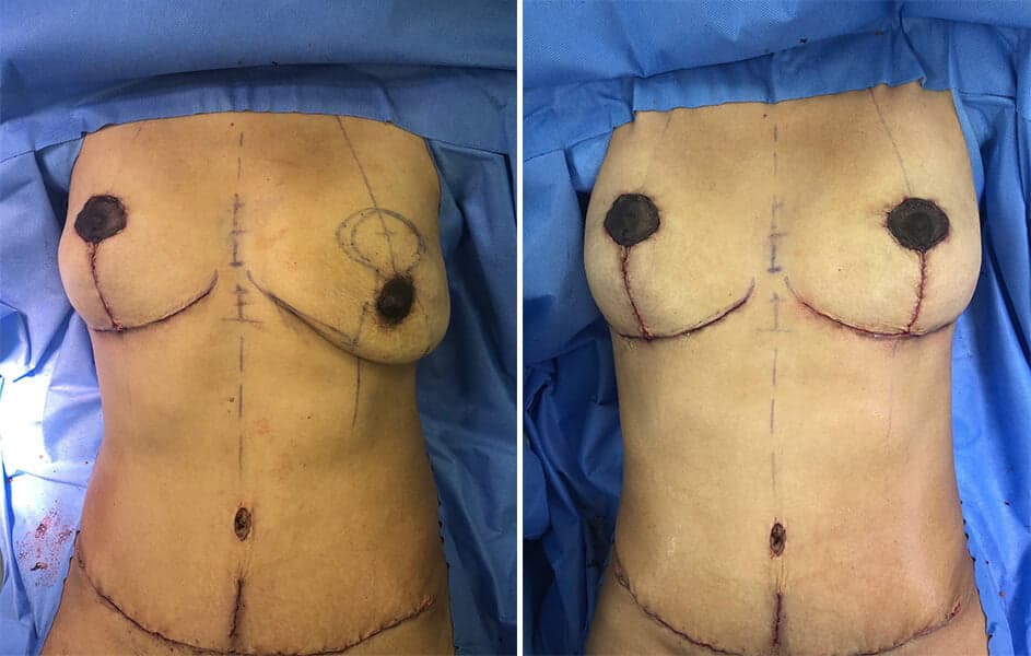 Video and images: Mini Tummy Tuck and Bi Lateral Mastopexy (Breast Lift)