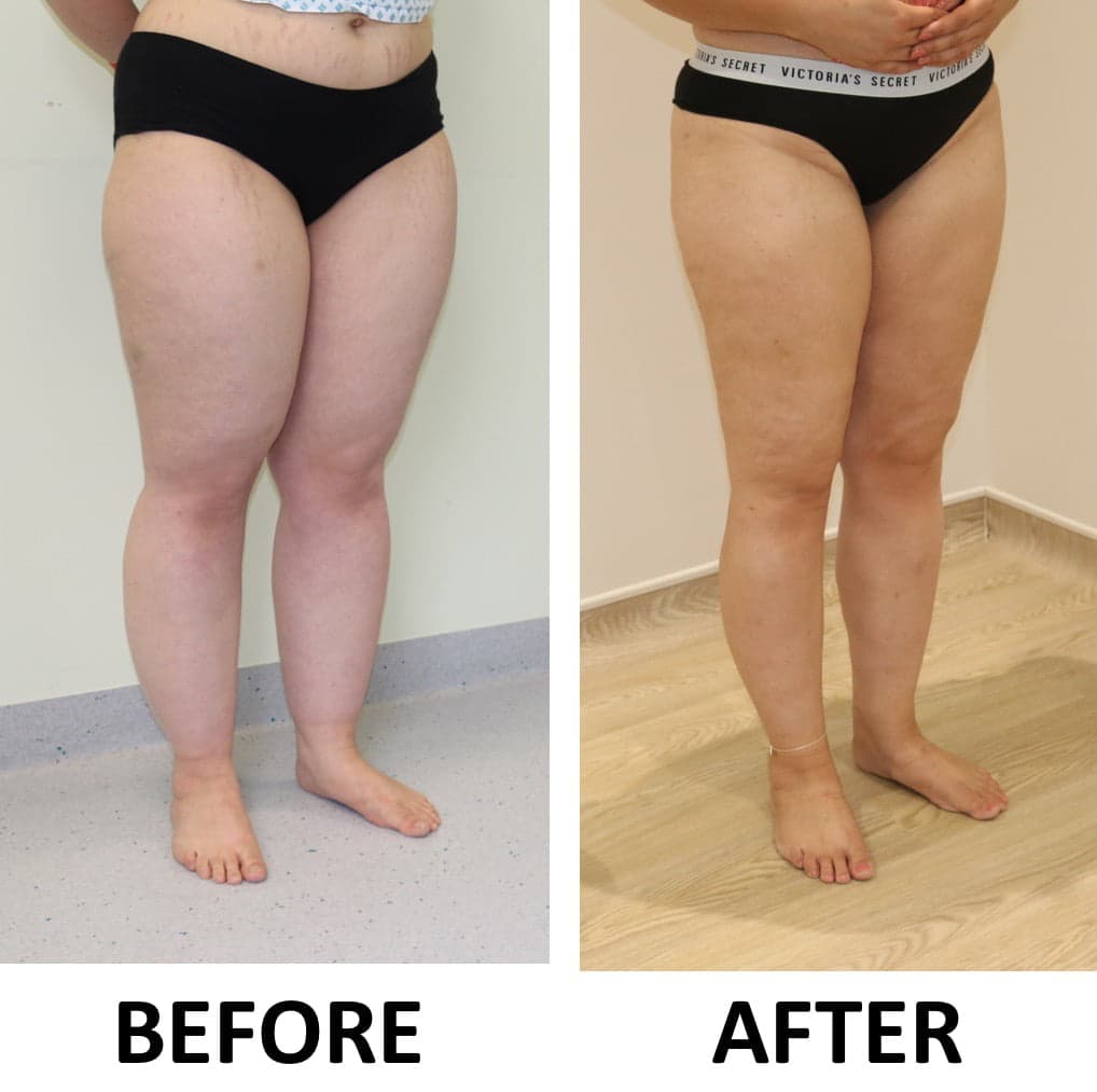 Lower Limb Lipoedema Liposuction