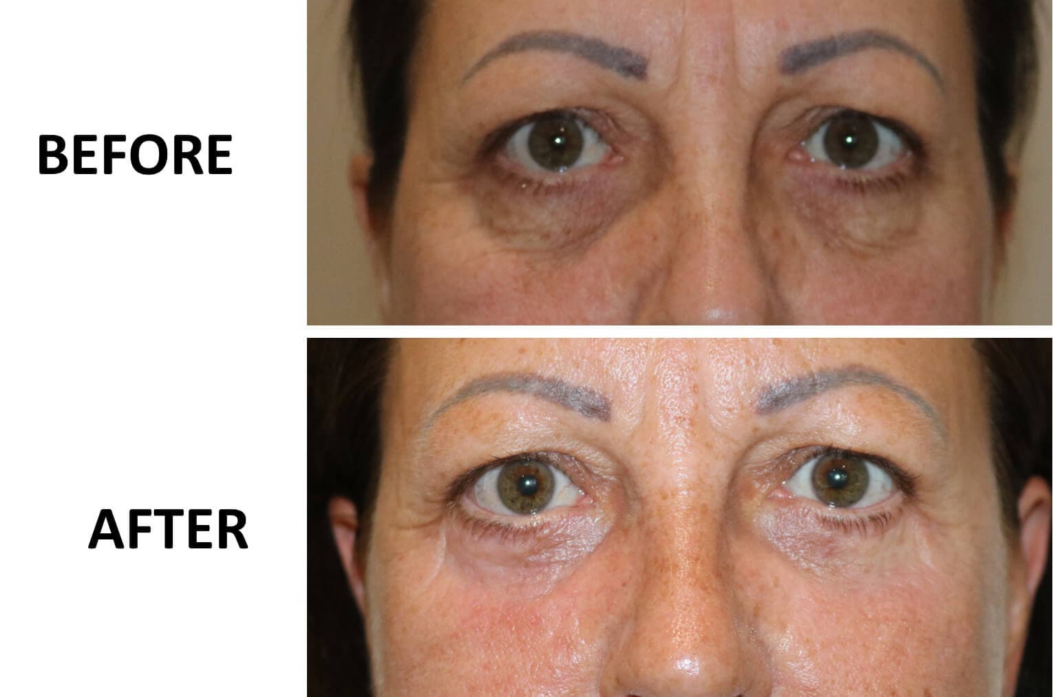 Lower Blepharoplasty