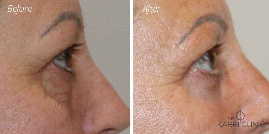 Before and After - Eyelid Surgery and Phenol Peel Under Sedation