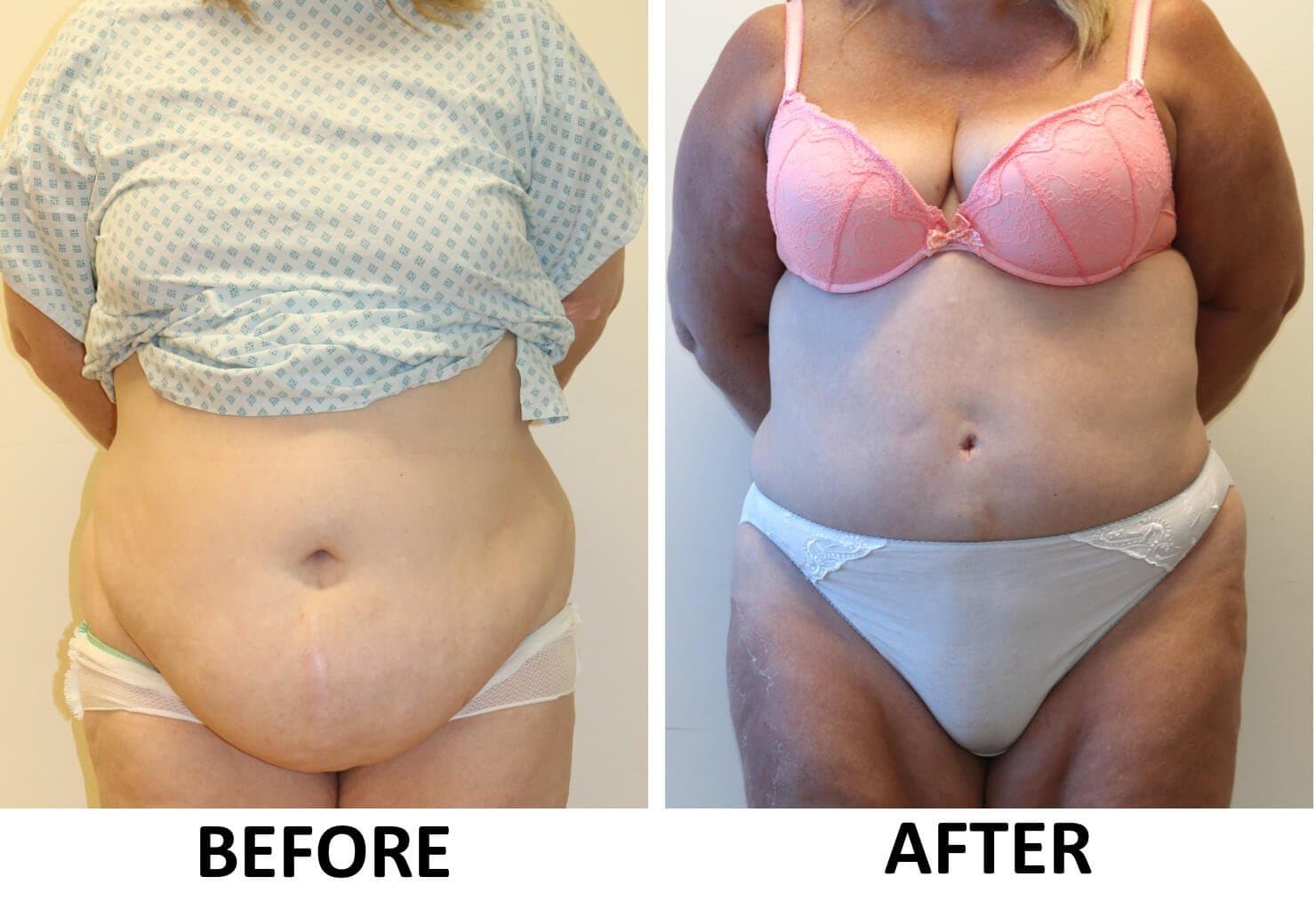 Tummy Tuck (Abdominoplasty)