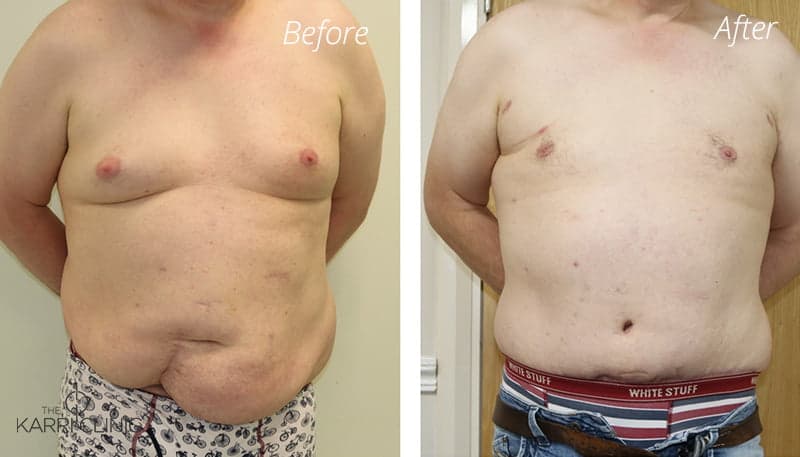 Daddy Makeover! Male Breast Reduction and Brazilian Tummy Tuck