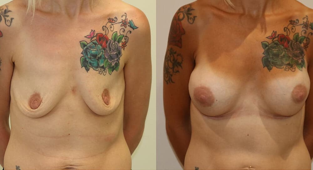 Before and After - A Natural Looking Breast Augmentation for Sagging, Deflated Breasts