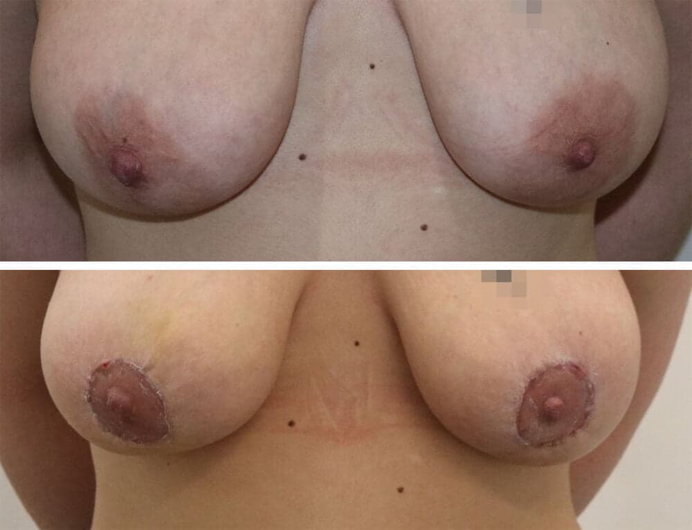 Before and After an Areola Reduction by Mr Karri at The Karri Clinic