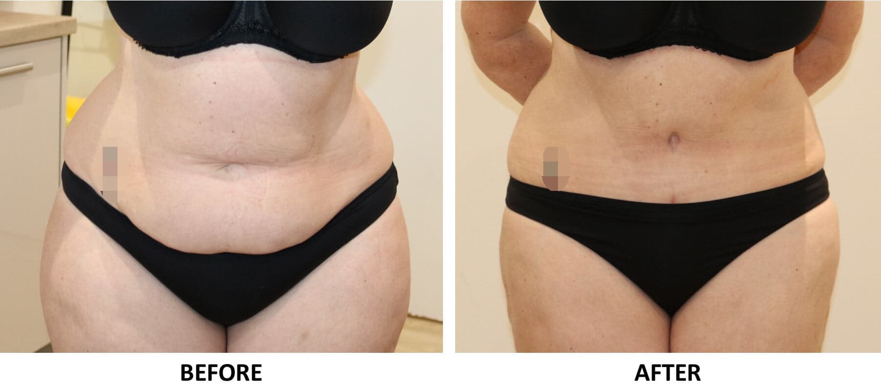 Tummy Tuck (Abdominoplasty)