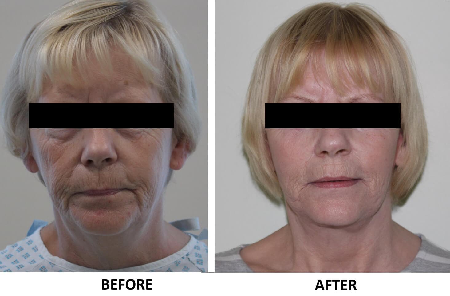 Facelift